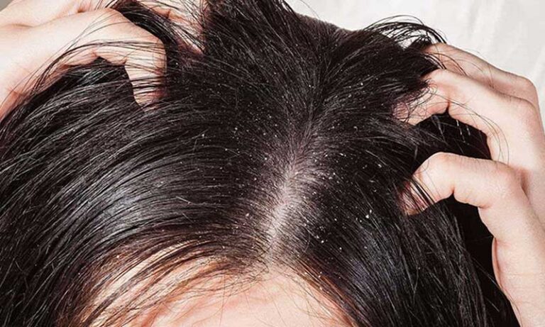 Dầu gội trị gàu nấm da đầu nào tốt nhất hiện nay