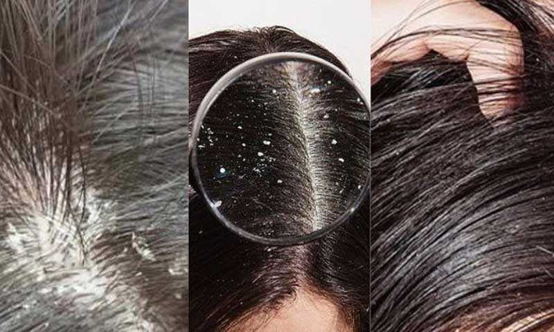 Dầu gội trị gàu và rụng tóc tốt nhất hiện nay
