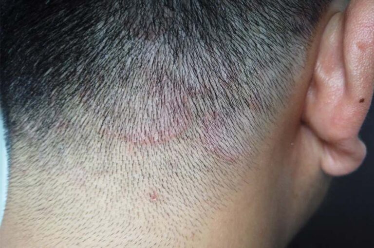 Nấm da đầu và cách điều trị - Những điều bạn cần biết