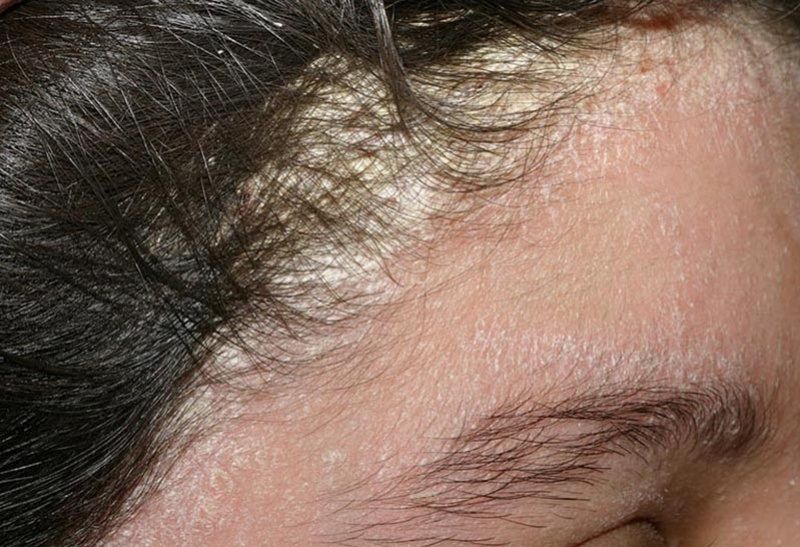 Nấm da đầu là gì? Nguyên nhân, cách nhận biết và điều trị