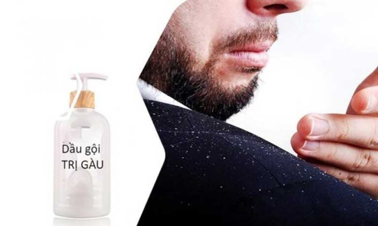 Tiết lộ dầu gội trị gàu "dứt điểm gàu" chỉ sau vài lần gội