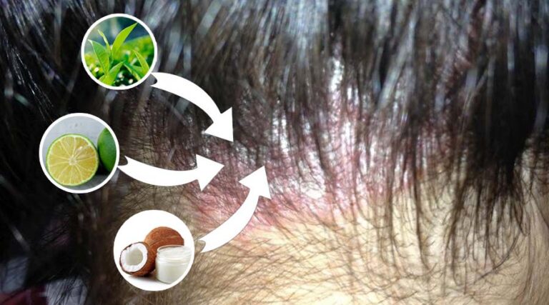 Trị nấm da đầu tại nhà - Cách hiệu quả và an toàn cho bạn