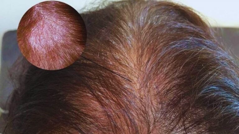 HÌnh ảnh bị nấm da đầu như thế nào?