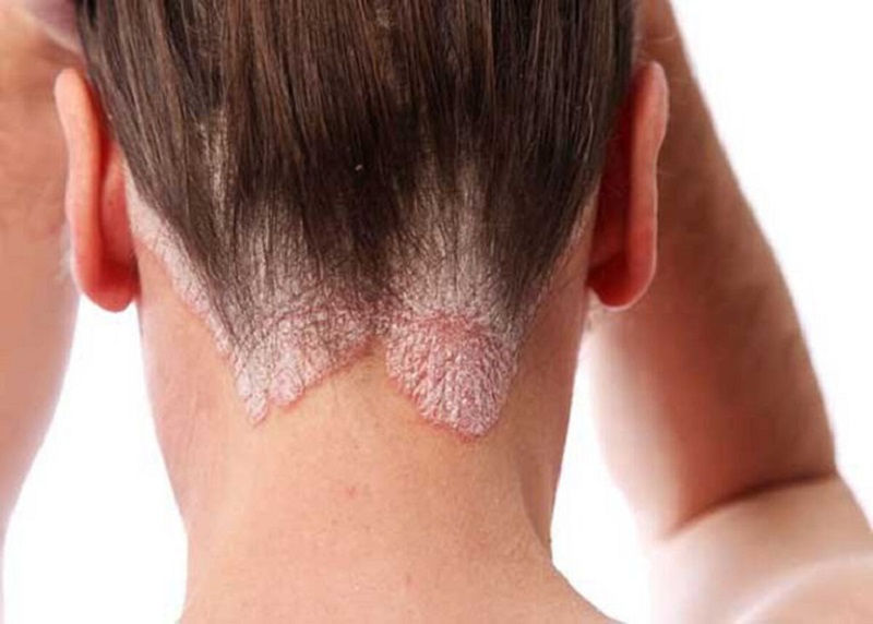 Nấm da đầu có lây không?