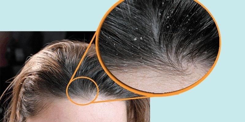 Dầu gội trị gàu dưỡng tóc top 1 hiện nay