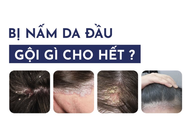 Bị nấm da đầu gội gì cho hết?