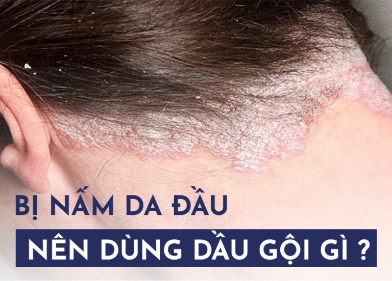 Bị nấm da đầu nên dùng dầu gội gì?