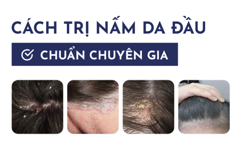 Cách trị nấm da đầu hiệu quả