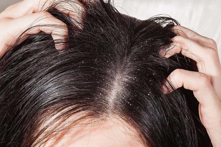 Bị nấm da đầu dùng dầu gội gì?