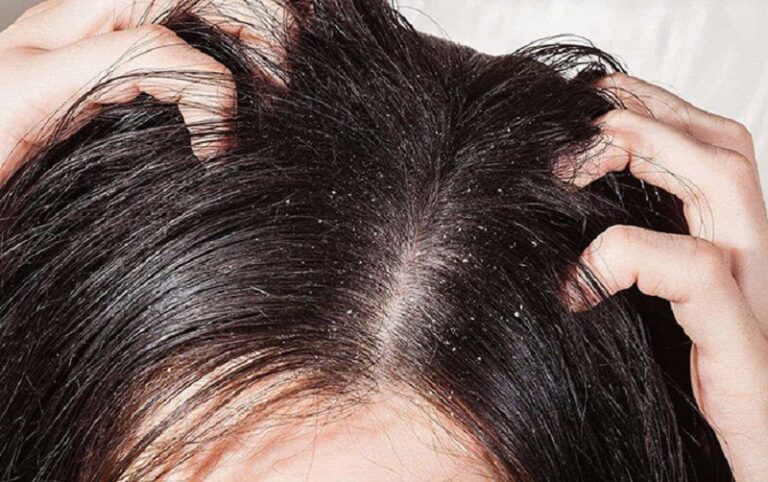 Trị nấm đầu như thế nào hiệu quả nhất?