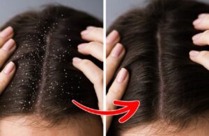 Review các loại dầu gội trị gàu hiệu quả nhanh phù hợp cho cả nam và nữ
