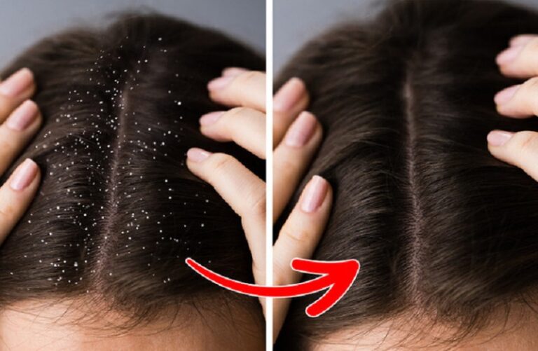 Các loại dầu gội trị gàu hiệu quả nhất hiện nay