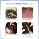 Combo Gàu Ngứa Thế Hệ Mới Santal X & Kem Bôi Stada 200